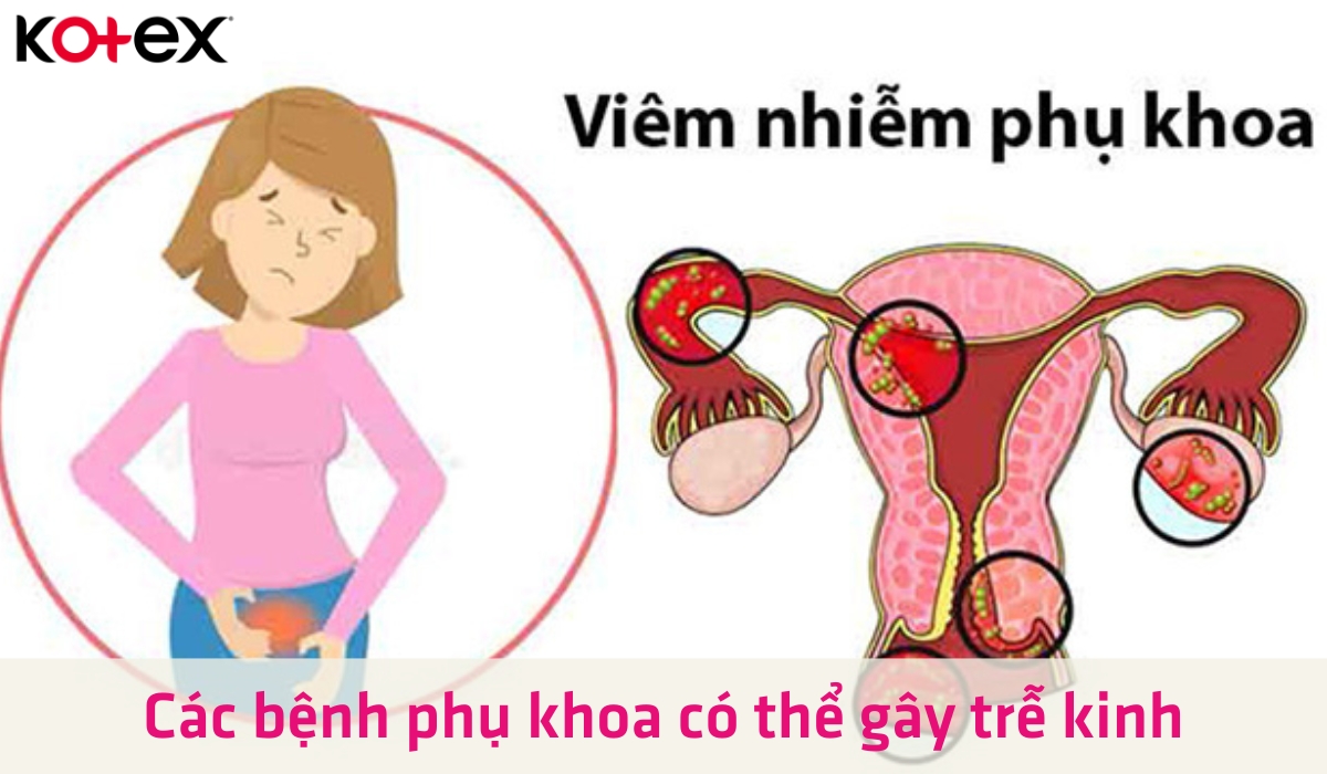 Viêm nhiễm phụ khoa