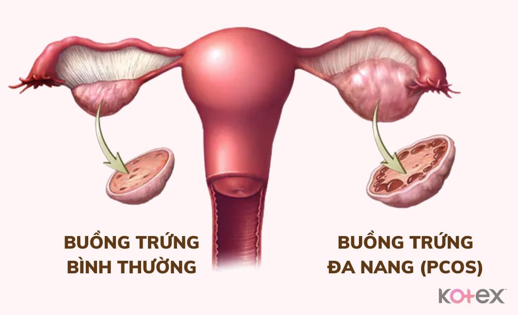 Bệnh phụ khoa buồng trứng đa nang