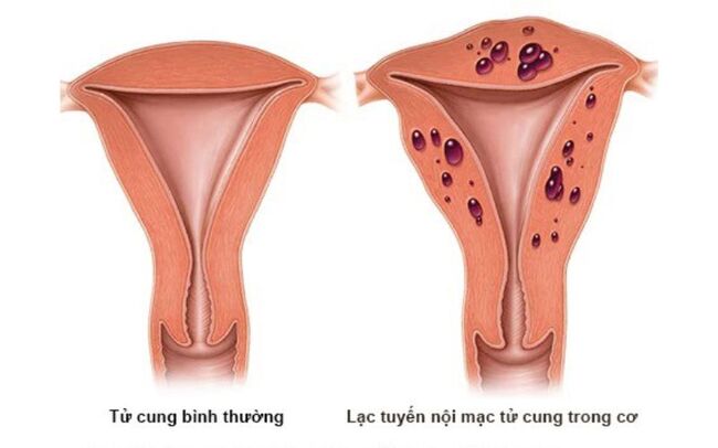 Bệnh lạc tuyến nội mạc tử cung làm đau bụng kinh dữ dội