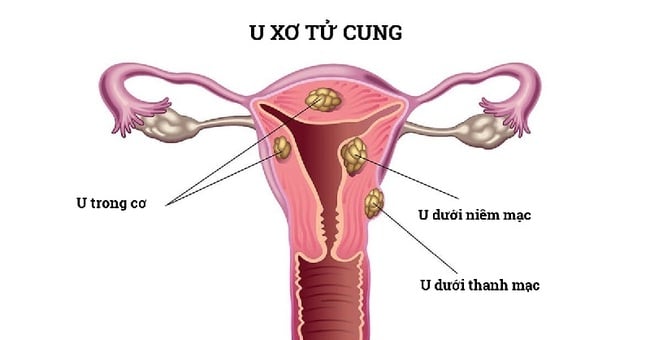 U xơ cổ tử cung có thể làm ra máu âm đạo, đau bụng kinh và buồn nôn