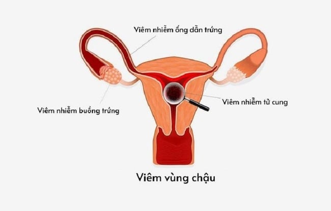 Bệnh viêm vùng chậu gây rối loạn kinh nguyệt và đau bụng kinh dữ dội