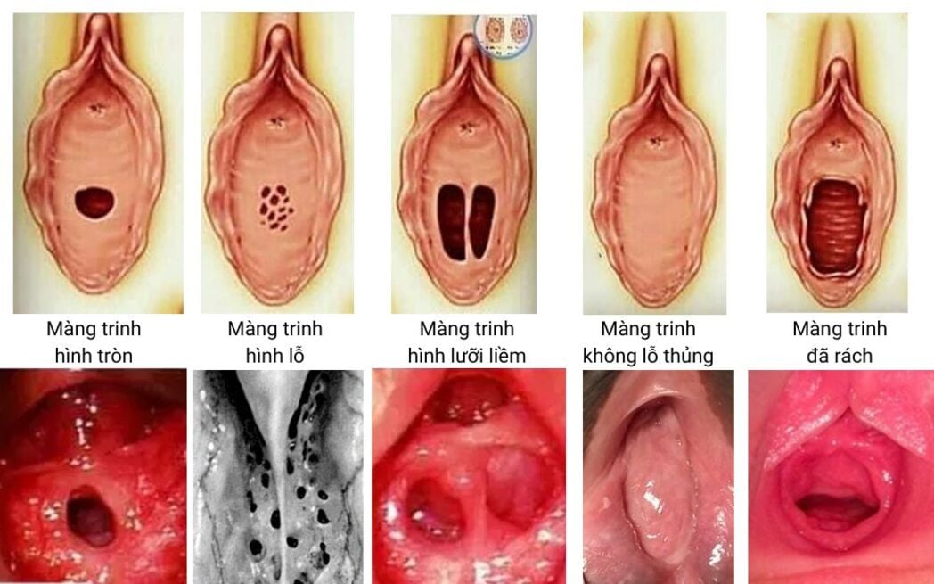 Hình dáng màng trinh (ảnh thật)