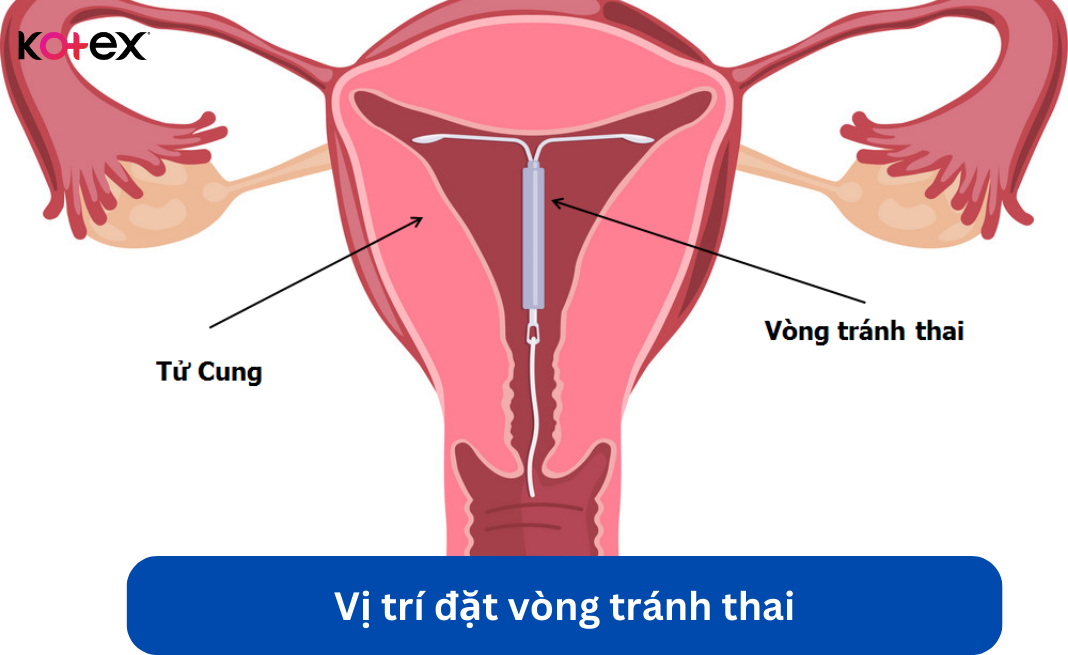 Vị trí đặt vòng tránh thai