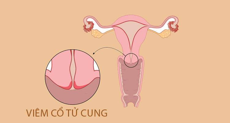 Viêm cổ tử cung là bệnh lý phụ khoa nghiêm trọng khiến khí hư tiết ra có mùi chua