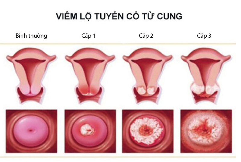 Khí hư đặc nhiều có thể “báo động” bệnh viêm lộ tuyến cổ tử cung giai đoạn 3 