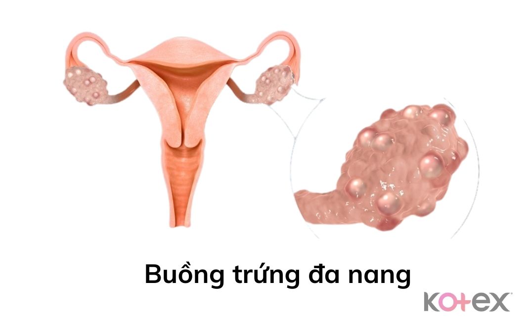 Hội chứng buồng trứng đa nang