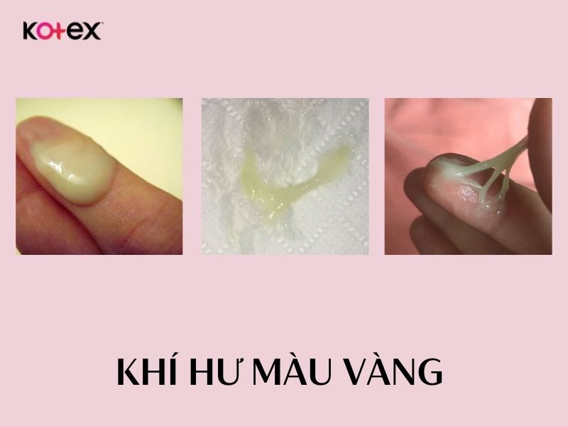 Khí hư màu vàng có bình thường không?