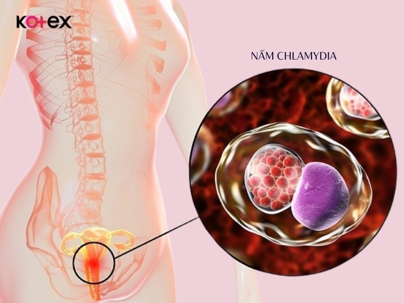 Viêm nhiễm nấm Chlamydia thường ra nhiều khí hư màu vàng