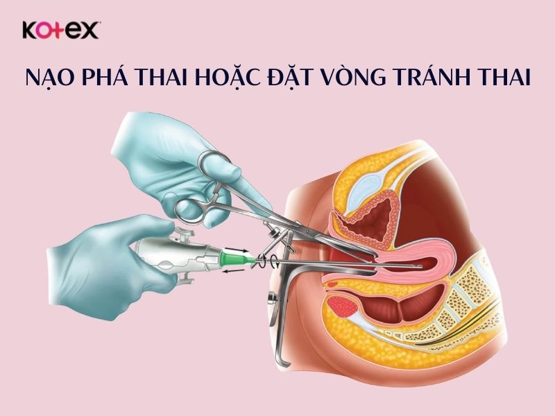 Nạo phá thai hoặc đặt vòng tránh thai