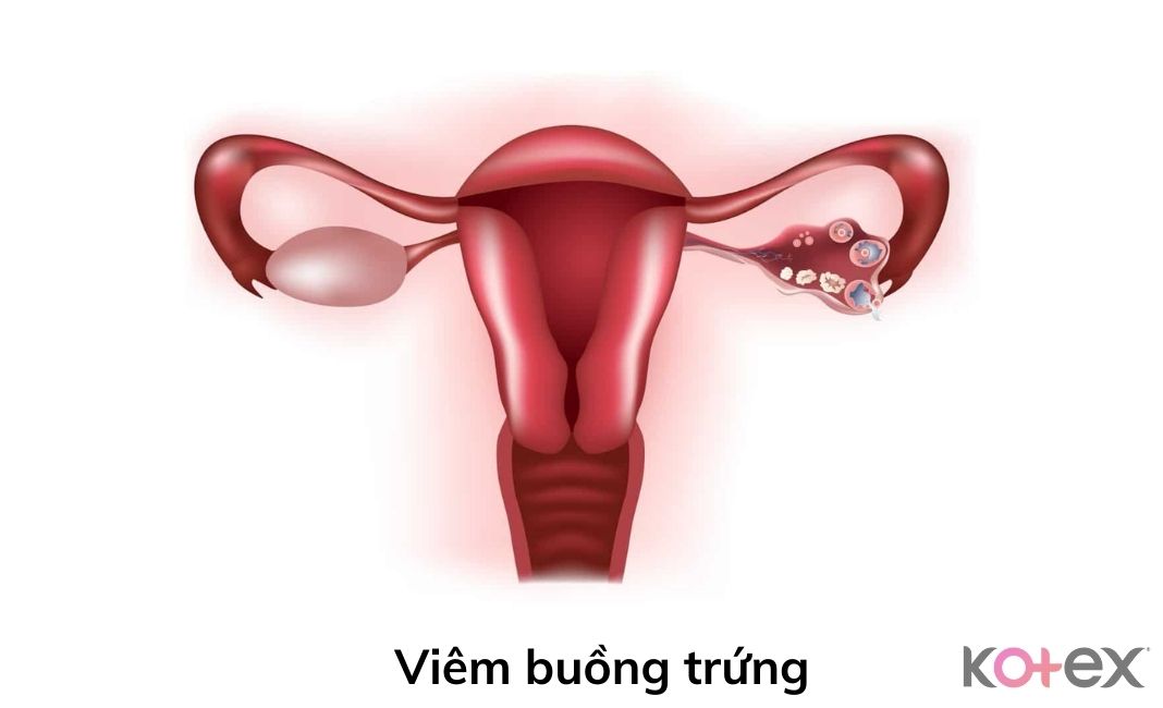 Viêm buồng trứng