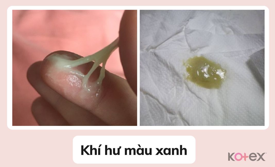 Hình ảnh khí hư màu xanh