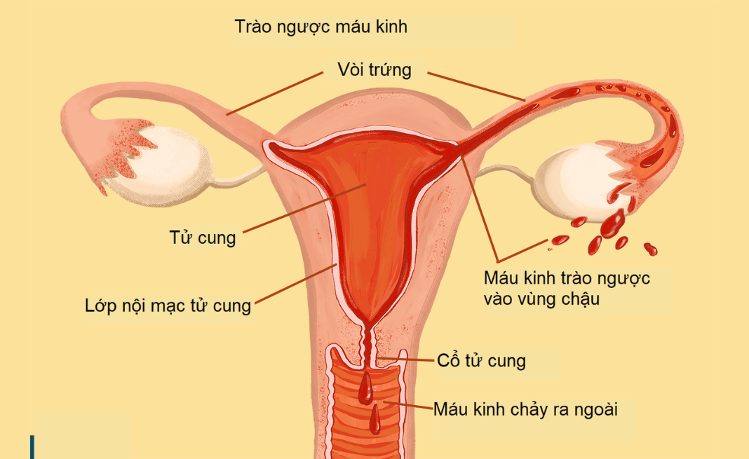 Kinh nguyệt trào ngược là nguyên nhân gây lạc nội mạc tử cung