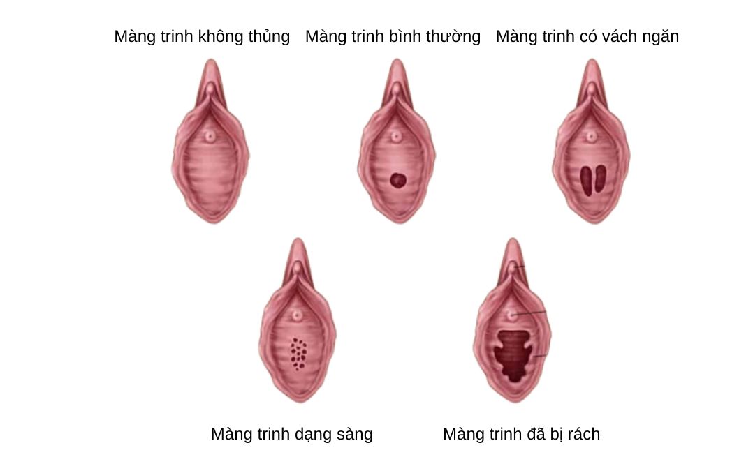 Hình dạng các loại màng trinh