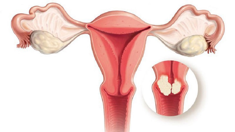 U xơ cổ tử cung thường xảy ra ở phụ nữ trong độ tuổi sinh sản