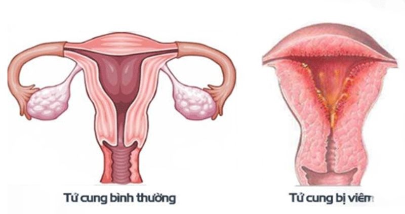 Các vi khuẩn do bệnh viêm nội mạc tử cung làm máu kinh xuất hiện dịch nhầy 