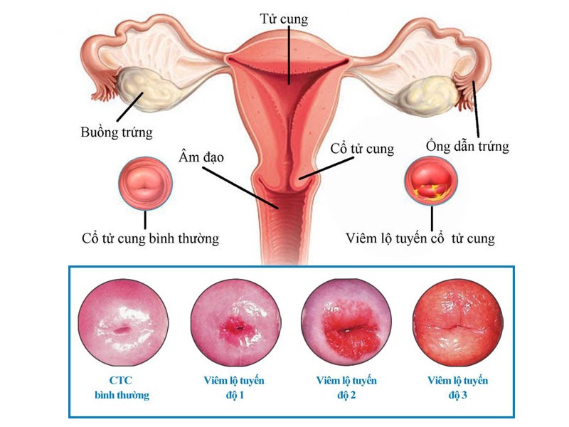 Máu kinh đi kèm dịch nhầy có thể triệu chứng của bệnh viêm lộ tuyến tử cung 