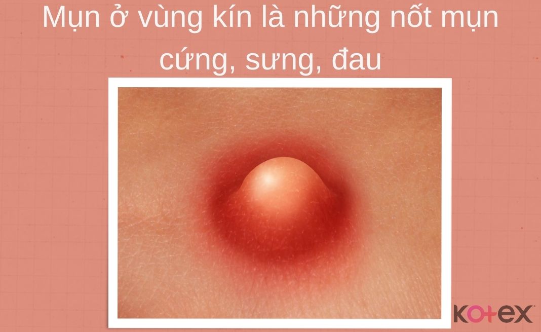 Hay Mọc Mụn Ở Vùng Kín: Nguyên Nhân, Cách Điều Trị Và Phòng Ngừa Hiệu Quả