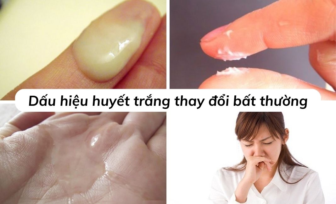 dấu hiệu huyết trắng thay đổi bất thường