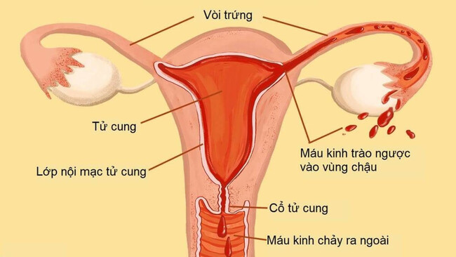 Để quên cốc nguyệt san trong âm đạo rất nguy hiểm