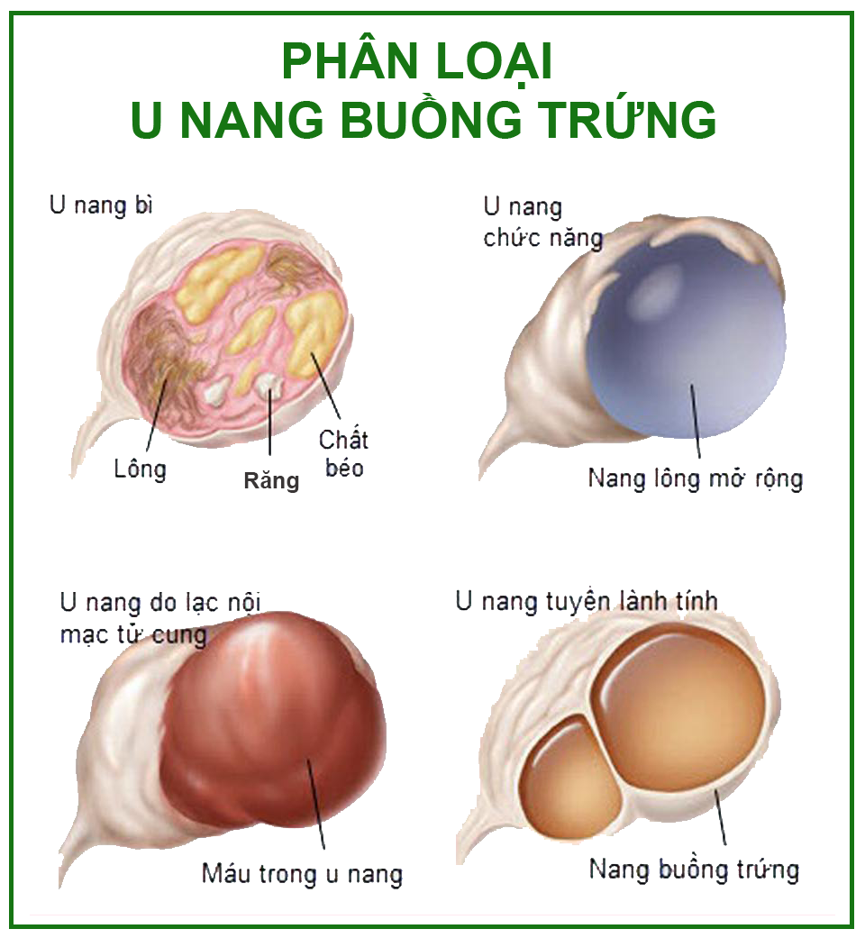 Căn cứ vào cấu tạo và tính chất của các loại khối u để phân loại u nang buồng trứng